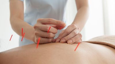Akupunktur, Påfølgende behandling hos Klinikk for Alle - Storo