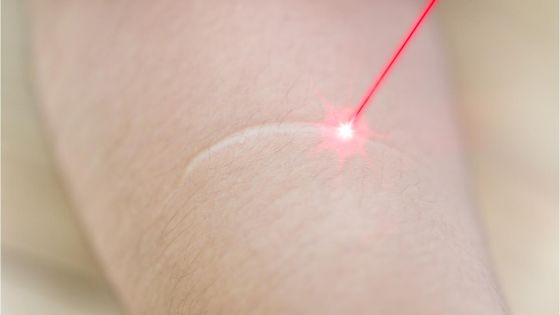 Arr behandling med laser